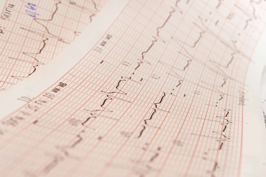 Критерії Сгарбосса діагностика інфаркту при БЛНПГ