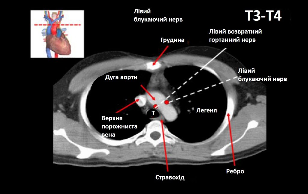 Комп'ютерна томографія грудної клітини, Комп'ютерна томографія, КТ, грудна клітина, грудна клітка, структури грудної клітини