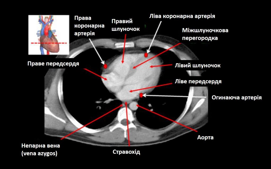 Комп'ютерна томографія грудної клітини, Комп'ютерна томографія, КТ, грудна клітина, грудна клітка, структури грудної клітини